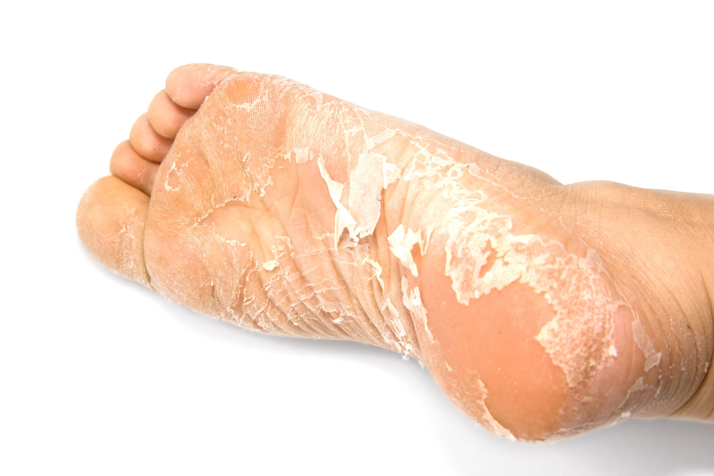 قناع تقشير القدم هو أحد أنواع الأقنعة التي يمكن لعملاء BIOCROWN شرائها.