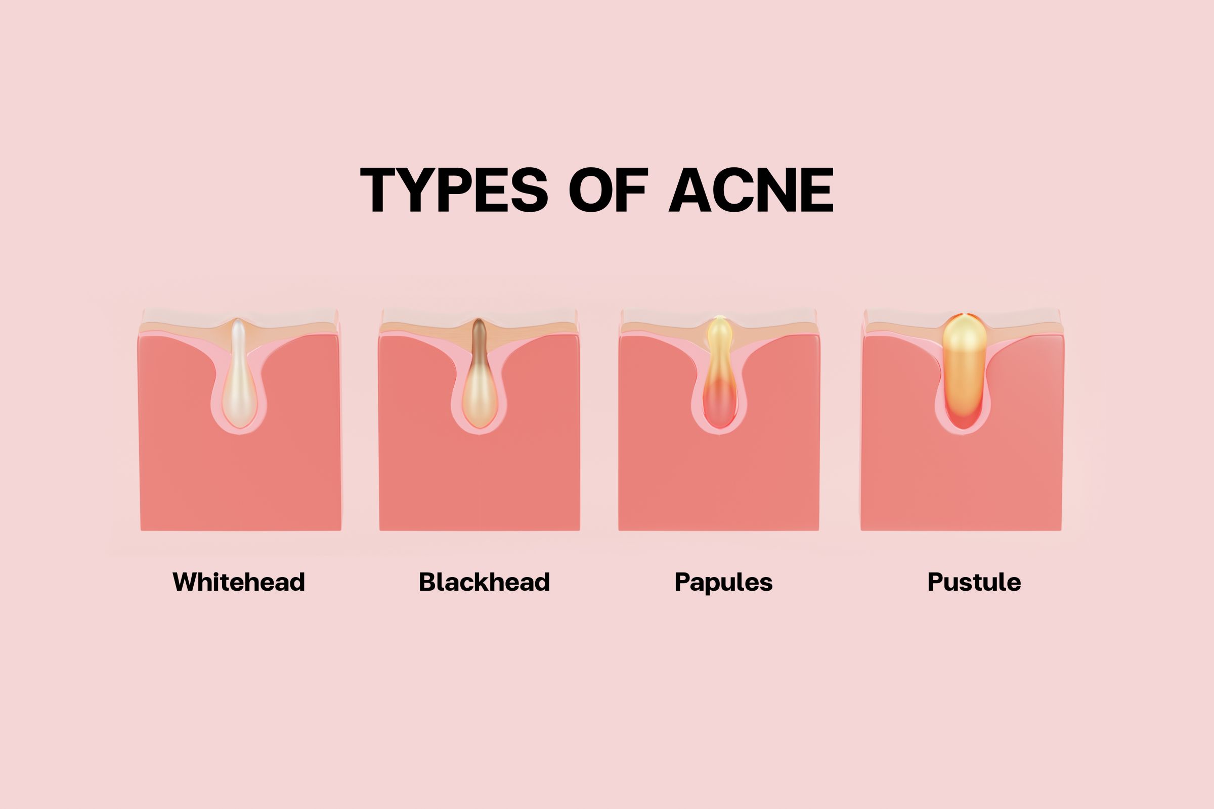 types of acne